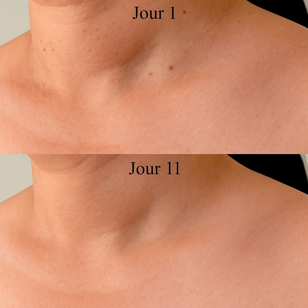 DermaClear Kit™ – Fini les verrues cutanées